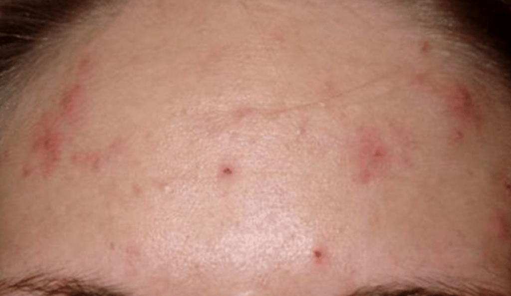 acne clinic - forehead acne