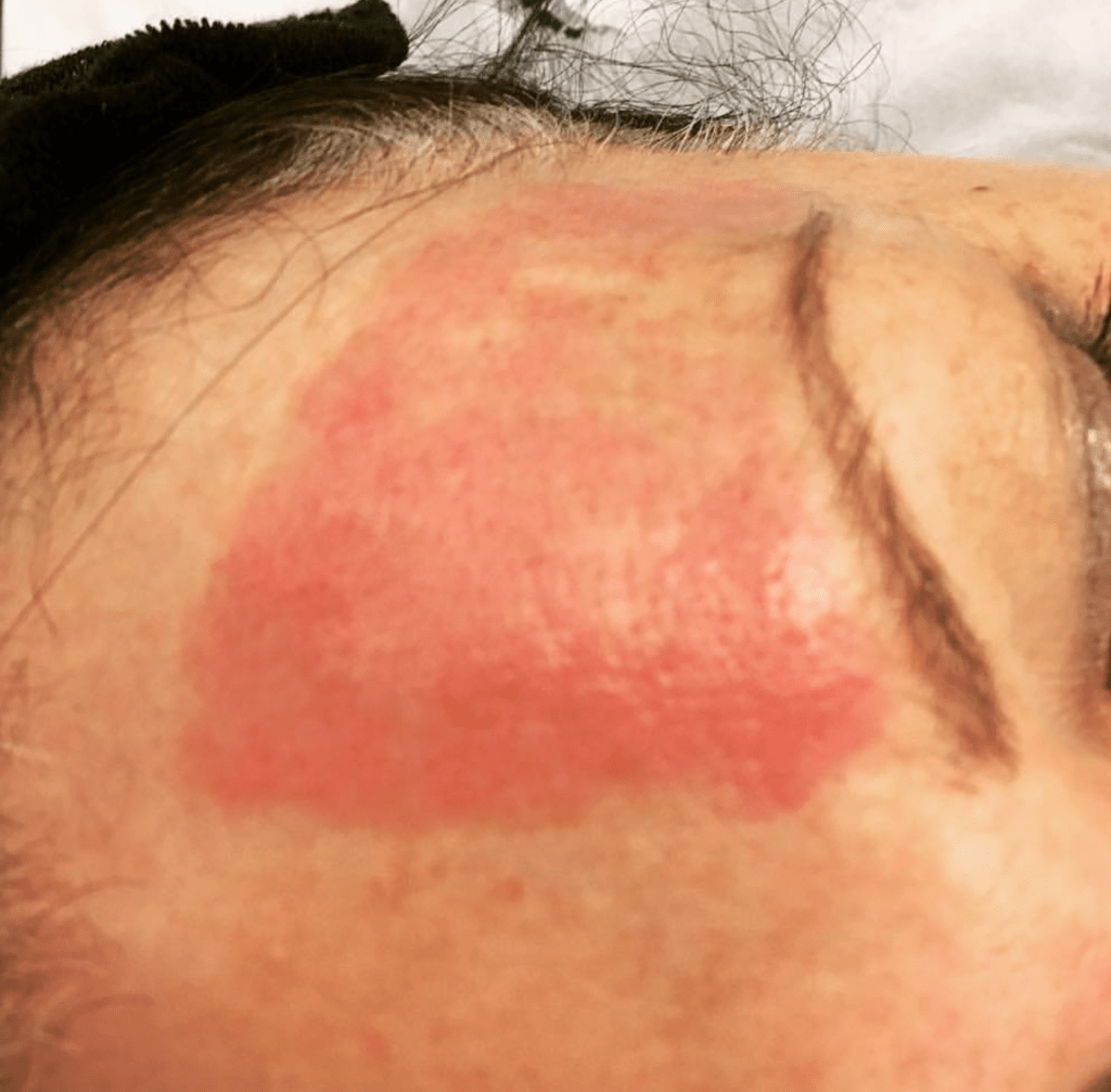 Microneeling redness / erythema