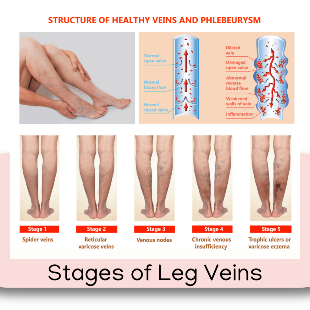 Stages of leg veins and treatment
