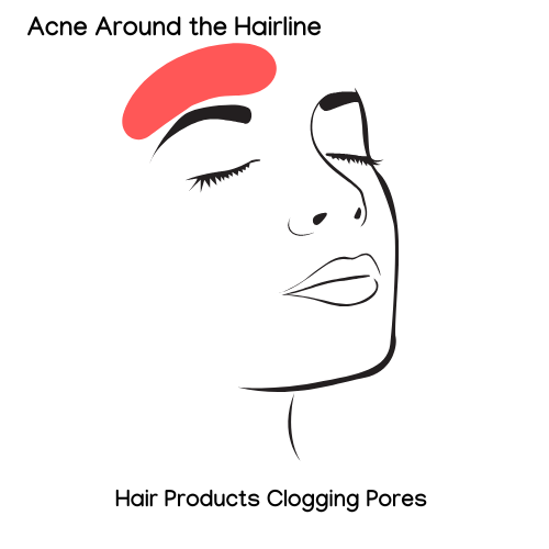 Acne Face Map of the Hairline