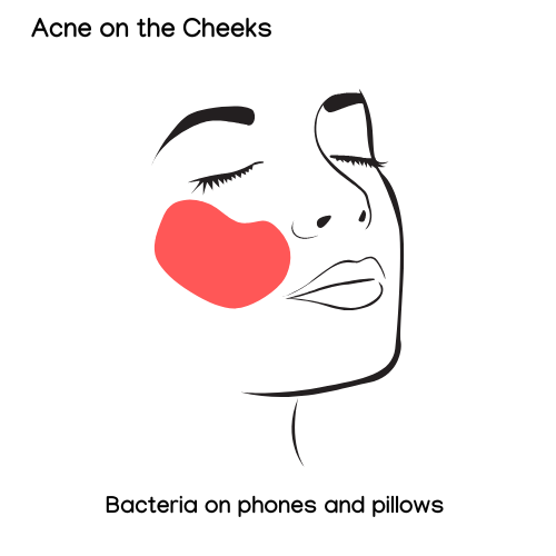 Acne Face Map of the Cheeks