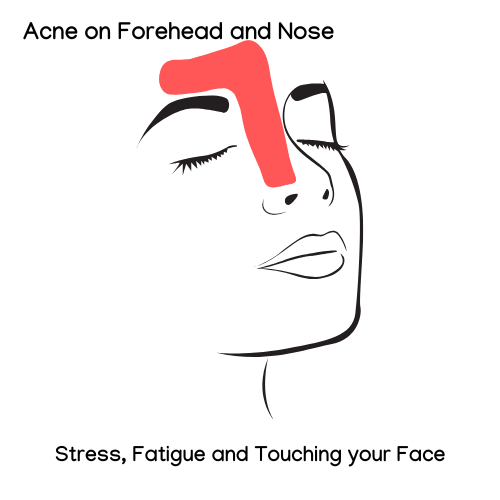 Acne Face map of the T Zone