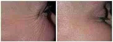 Azzalure crows feet