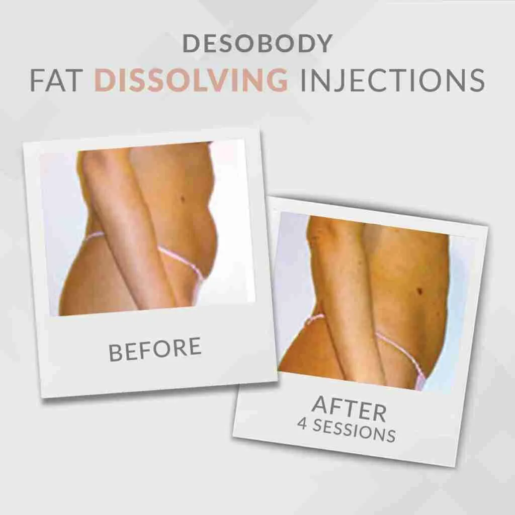 Before and after fat dissolving injections