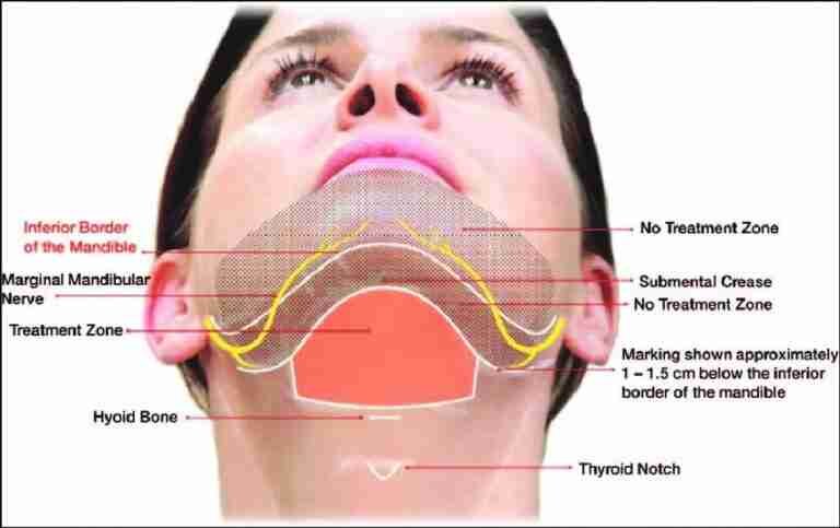 Double Chin Treatment 