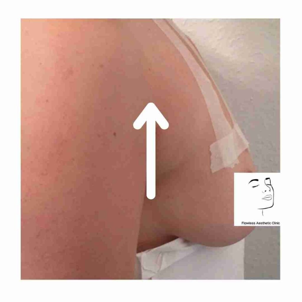 Breast lift