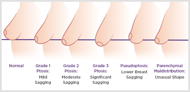 What Is the Best Age for a Breast Lift?