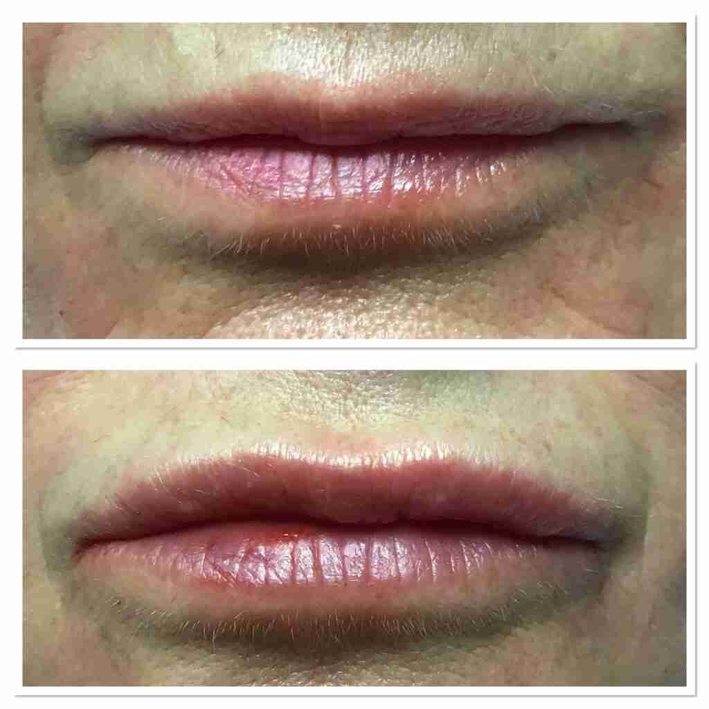 Subtle lip fillers – Flawless Aesthetic Clinic