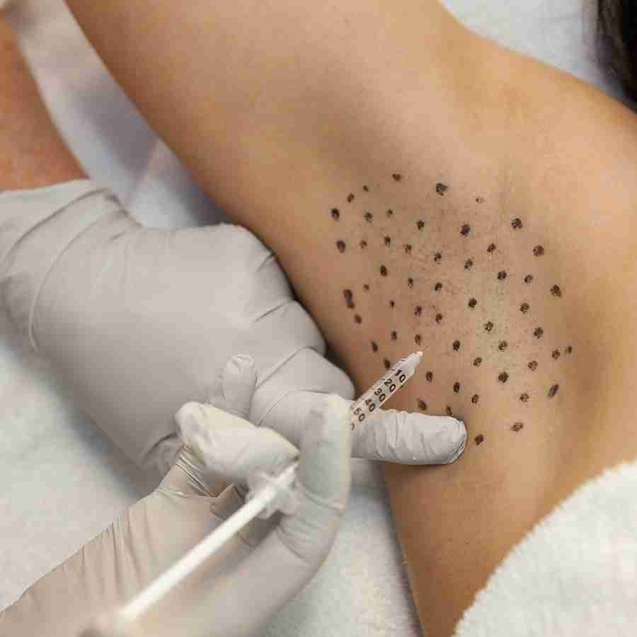 Botox for excessive Sweating