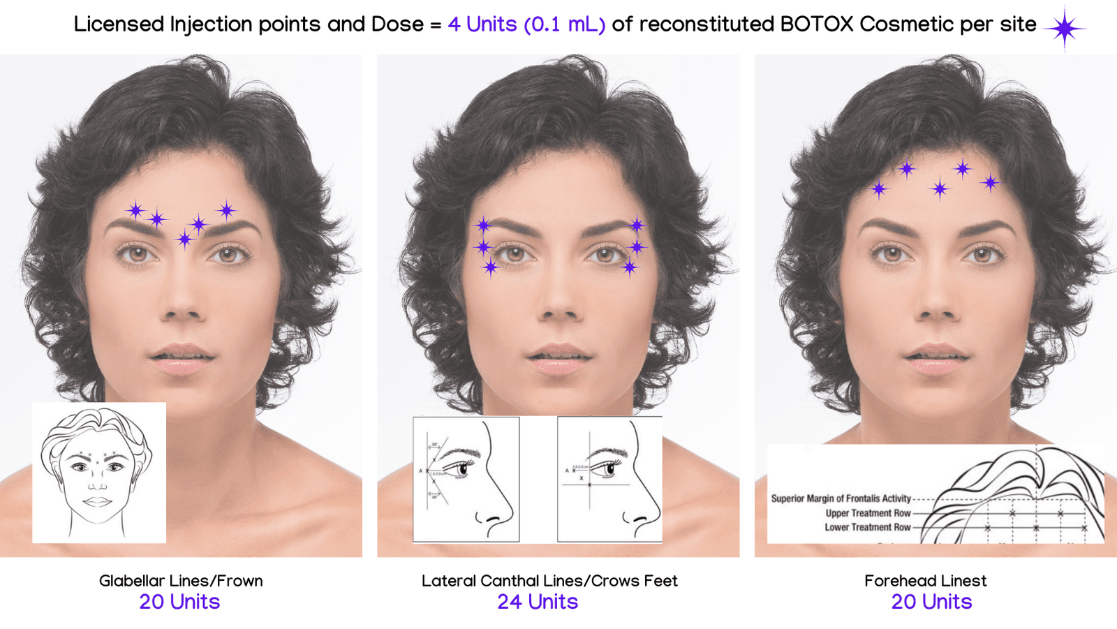 Licensed Injection Points And Dose 4 Units 01 Ml Of Reconstituted Botox Cosmetic Per Site 9994