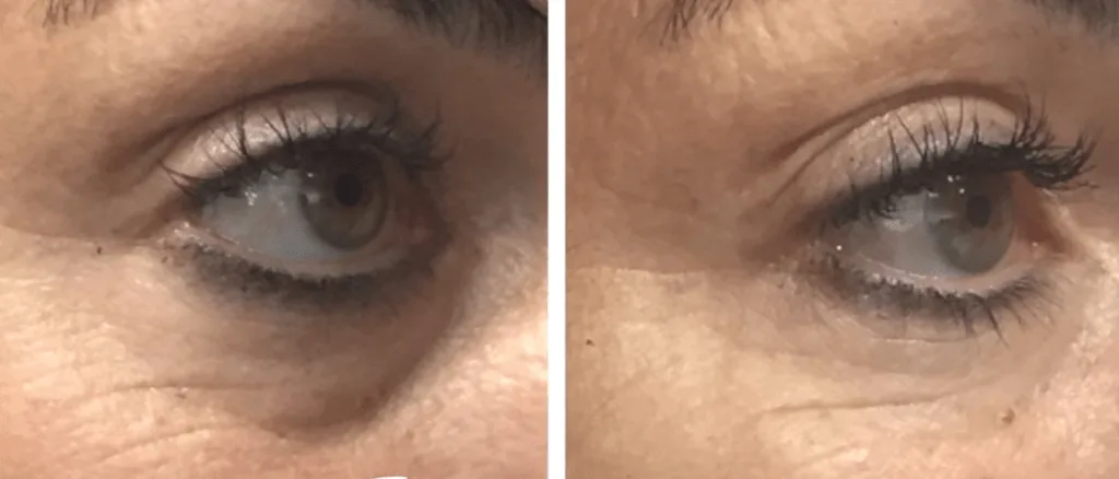Tear Trough Filler before and after