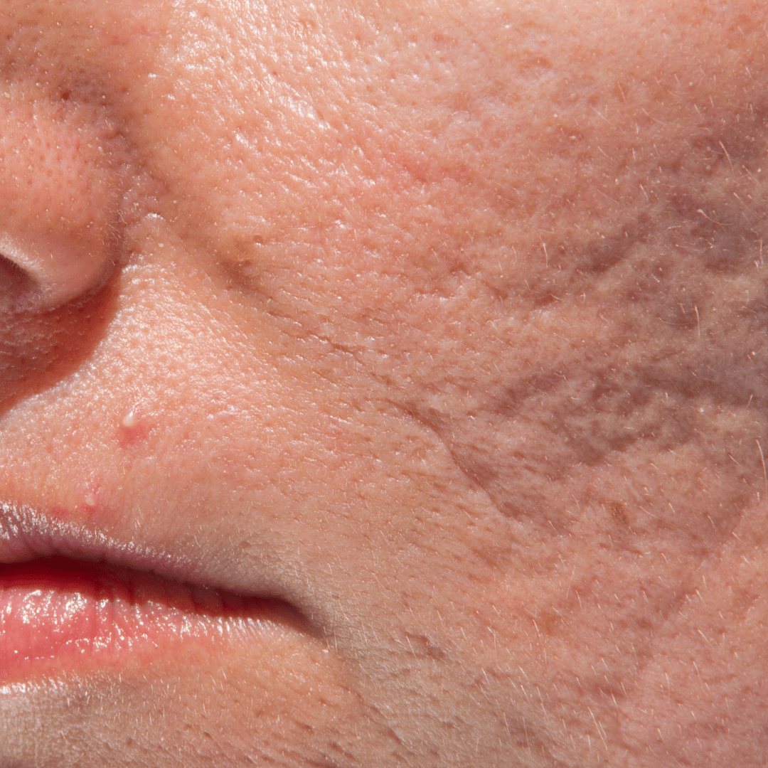 Dermal Filler for Saggy Jowls